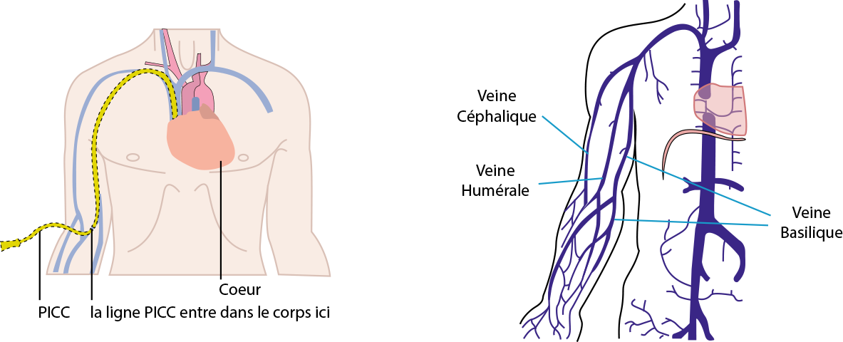 Picc Line, cathéter veineux, cabinet d'anesthésie à Besançon